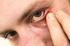 treatments for ocular rosacea