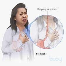 esophageal spasms causes how to get