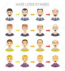 Information Chart Of Hair Loss Stages And Types Of Baldness Illustrated