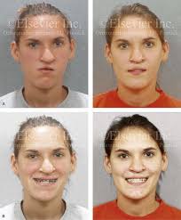 33 cleft orthognathic surgery the