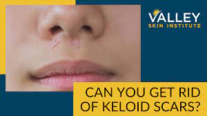 can you get rid of keloid scars