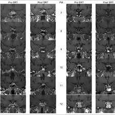 Coronal Mri Post Gadolinium Images At The Level Of The