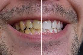 yellow teeth with home remes
