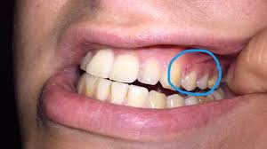 An mundfäule erkranken meist kinder. Was Haben Diese Punkte Auf Meinem Zahnfleisch Zu Bedeuten Mundfaule Gesundheit Und Medizin
