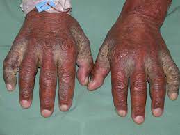 scabies rashes identification