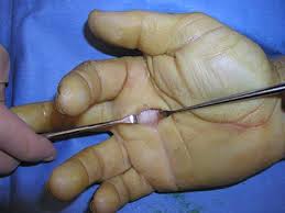 surgical photos for trigger digit