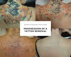 The cost of tattoo removal depends on the clinic, as each one will price differently — some charge by the square inch, some by a generic size (such as a postage stamp or credit card size), or a flat fee per treatment. Laser Tattoo Removal Chesapeake Dermacare Of Hampton Roads 757 317 3744