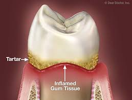 treating gum disease without surgery