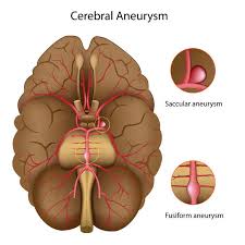 Brain Aneurysm Headway