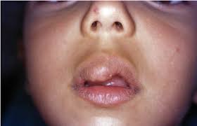 haemangioma in the upper lip