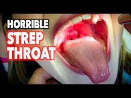 horrible strep throat dr paul you