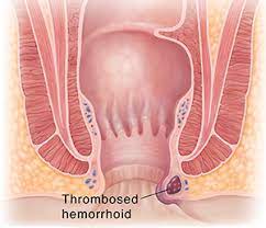 When these veins swell, blood pools and causes the veins to expand. Thrombosed Hemorrhoids