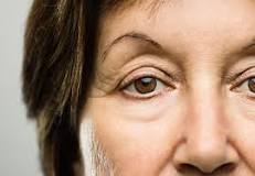 How To Fix Droopy Eyelids, Circles and Sags – Cleveland Clinic