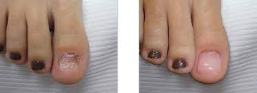 toenail reconstruction aurora foot