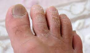 coconut oil for foot fungus how to