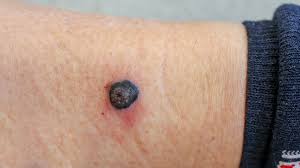 Melanoma is one of the most serious forms of cancer, and because its appearance can closely mimic natural moles, freckles, and age spots, it can be easy to overlook. Melanoma Signs Stages Causes And Photos