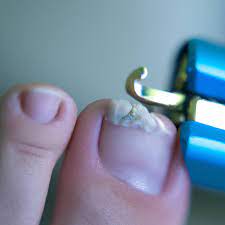 softening hard toenails natural