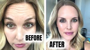 botox before after 8 day