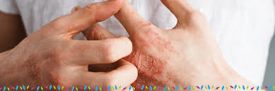eczema treatment in phoenix az