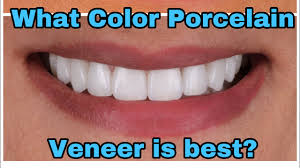 what color porcelain dental veneer is