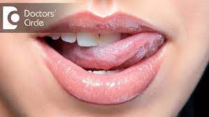 what causes white tongue can kissing