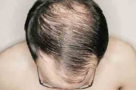 best alopecia treatment clinic in delhi
