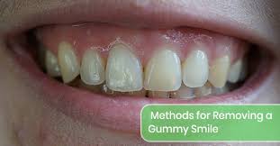 methods for removing a gummy smile