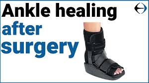 your ankle to heal after surgery