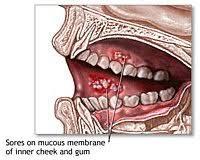 Mundsoor ist ein mundpilz und gehört zu der gattung hefepilzen der candida albicans. Mundsoor Kandidose Soor Im Mund Symptome Behandlung