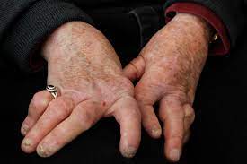 psoriatic arthritis on hands symptoms