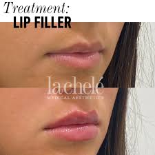 your questions answered lip filler