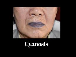 cyanosis you
