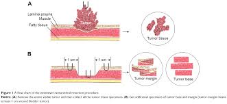 Full Text The Value Of Extensive Transurethral Resection In