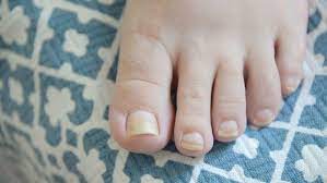 what can you do about yellow nails