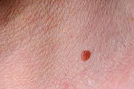 9 sneaky warning signs of melanoma you