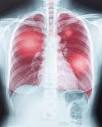 40% of COVID pneumonia patients still had lung problems at 1 year ...