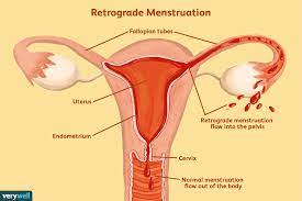 retrograde menstruation symptoms