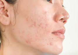 what causes acne scars how to prevent