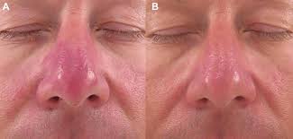 ipl treatment of red nose rosacea