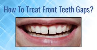 Also make notes on any other imperfections that you would like to fix along with your gaps (tooth size, color, straightness, chips, etc.). How To Get Rid Of Front Teeth Gaps In Leicester Straight Teeth Suite