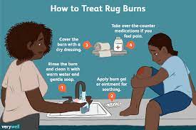 rug burns symptoms severity treatment