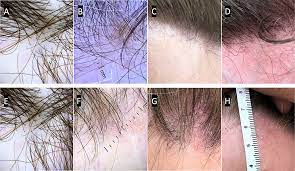 treatment of frontal fibrosing alopecia