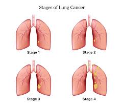 lung cancer symptoms causes