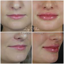 lip filler a variety of techniques