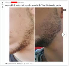 beard doesn t grow on cheeks here s