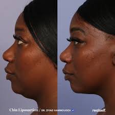 How much is chin lipo uk. How Chin Liposuction Gets Rid Of A Double Chin Realself Chin Liposuction Liposuction Alternatives Liposuction