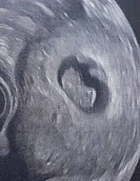 Das ungeborene wird ab jetzt als fötus bezeichnet. Ultraschallbilder Mehr Als 50 Bilder Aus Der Schwangerschaft Faminino