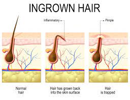 how to stop ingrown hairs anil shah