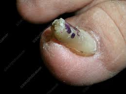 pincer nail deformity stock image