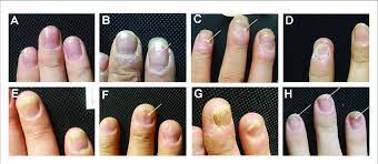 nail involvement of psoriasis